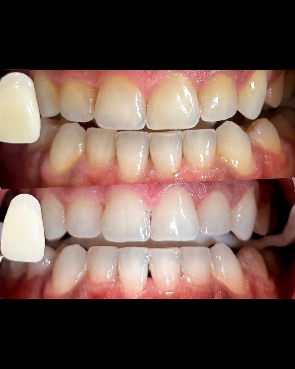 Patient 611 after whitening